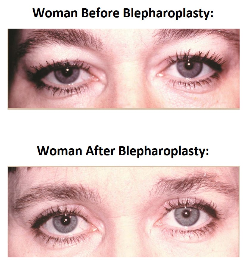 Female Blepharoplasty Before and After Comparison