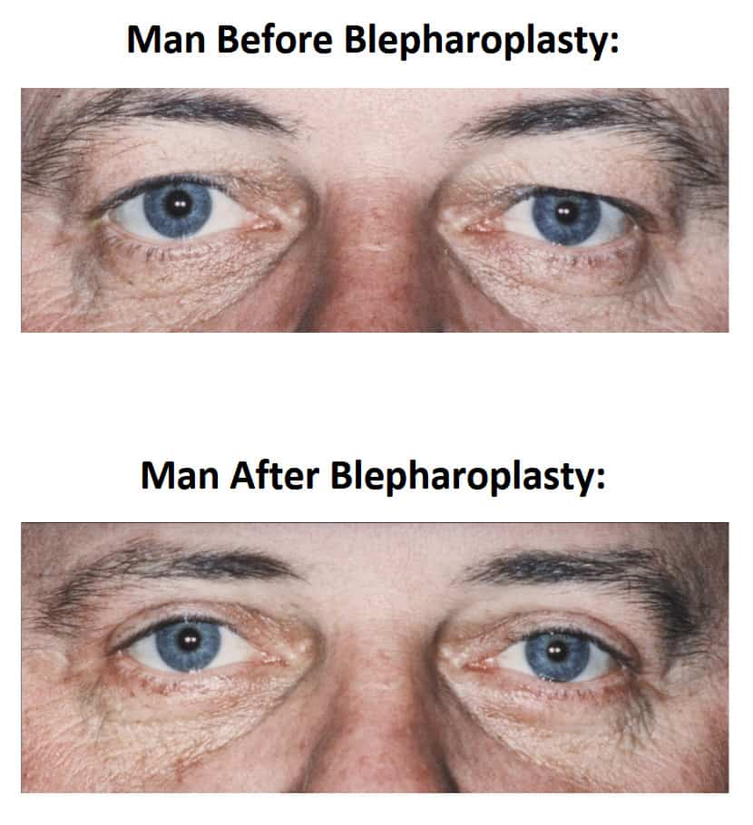 Male Blepharoplasty Before and After Comparison