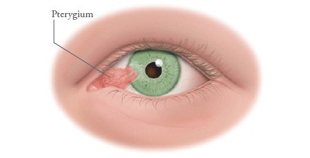 Pterygium Diagram