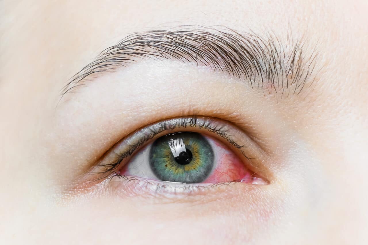 dry eyes