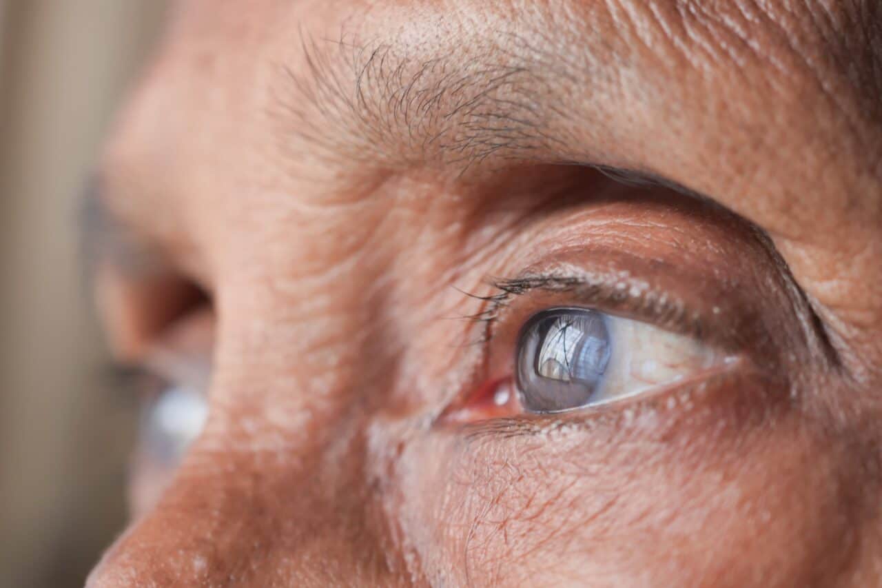 stages of cataracts