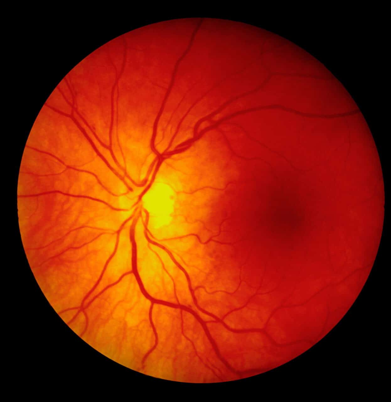 hypertensive retinopathy