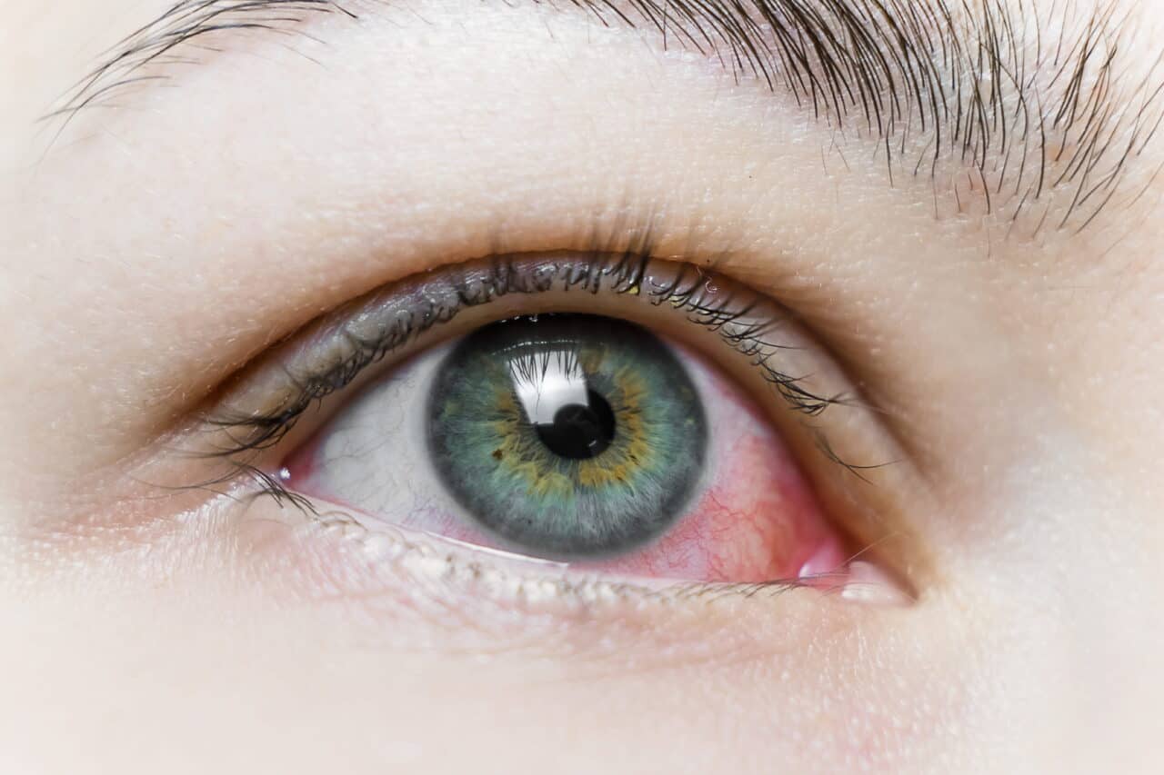 dry eye vs allergies