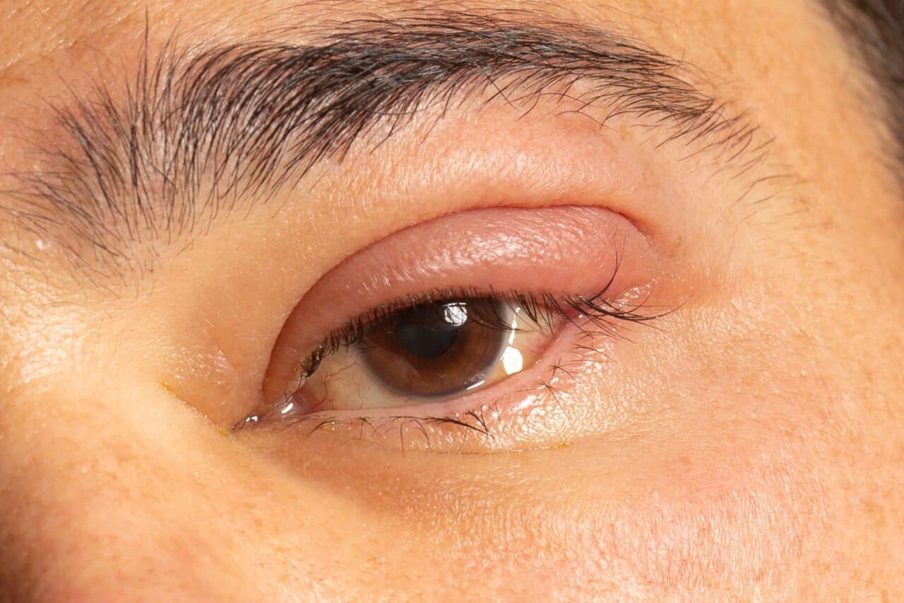 eye suffering from blepharitis